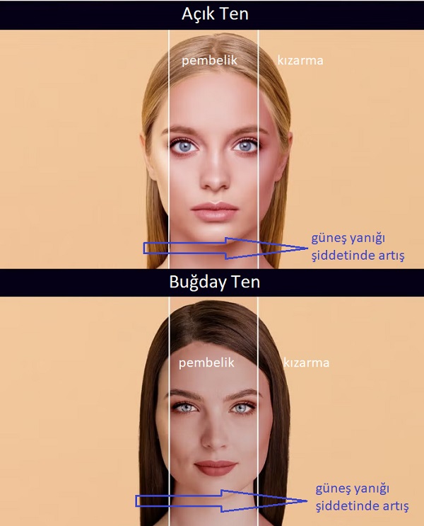 gunes_yanikleri_ve_cilt_kizarmasi.jpg