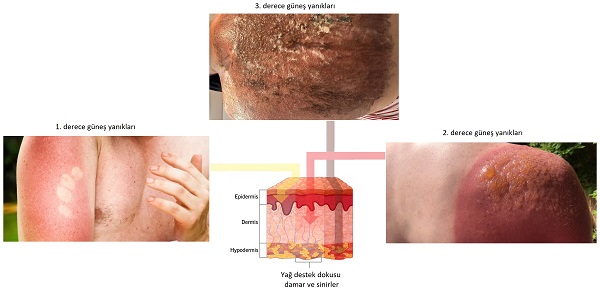 gunes_yanikleri_ve_dereceleri.jpg