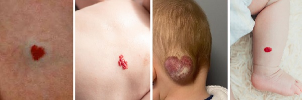 Infantil Hemanjioma Klinik Skorlama Sistemleri  