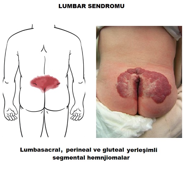 hemanjioma_LUMBAR_sendromu.jpg