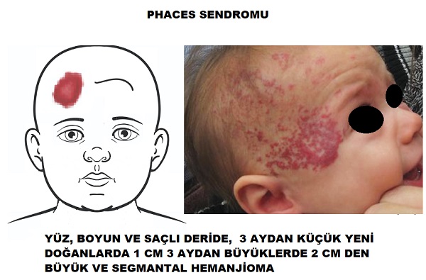 hemanjioma_PHACES_sendromu.jpg