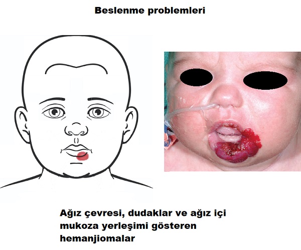 hemanjioma_beslenme_bozuklugu.jpg