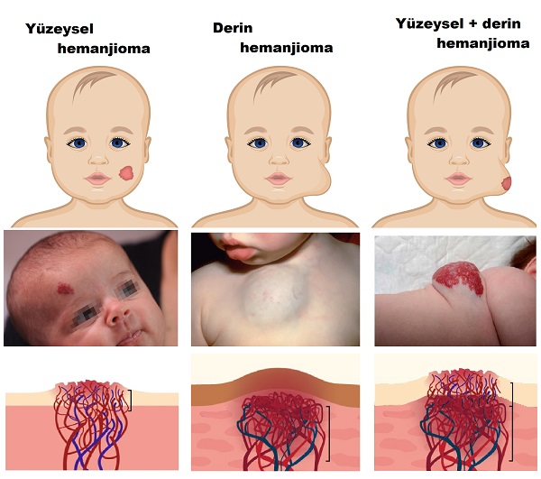 hemanjioma_derin_yuzeysel_klinik_formlari.jpg