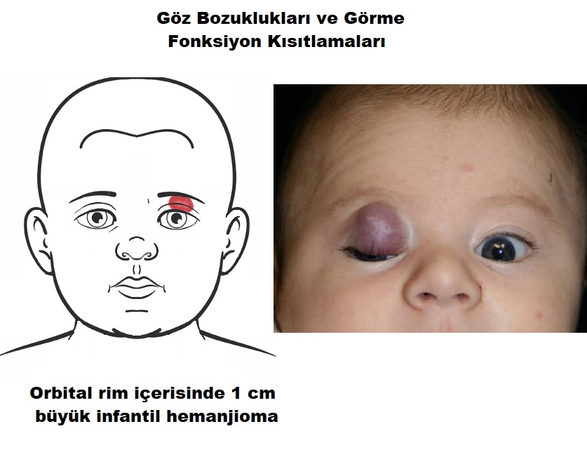 hemanjioma_goz_ve_gorme_bozukluklari_jpg.jpg