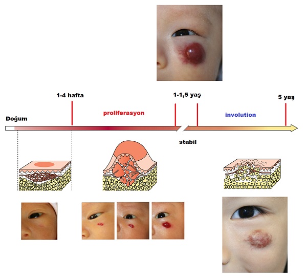 hemanjioma_klinik_evreleri.jpg