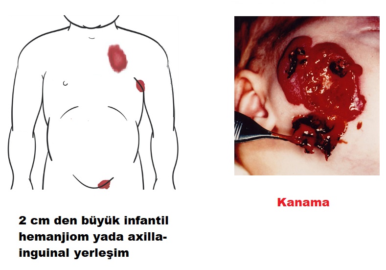 hemanjioma_ulser_ve_kanama.jpg