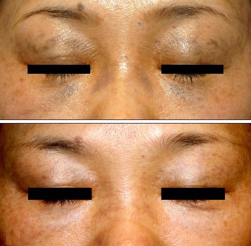 horri-nevus.jpg