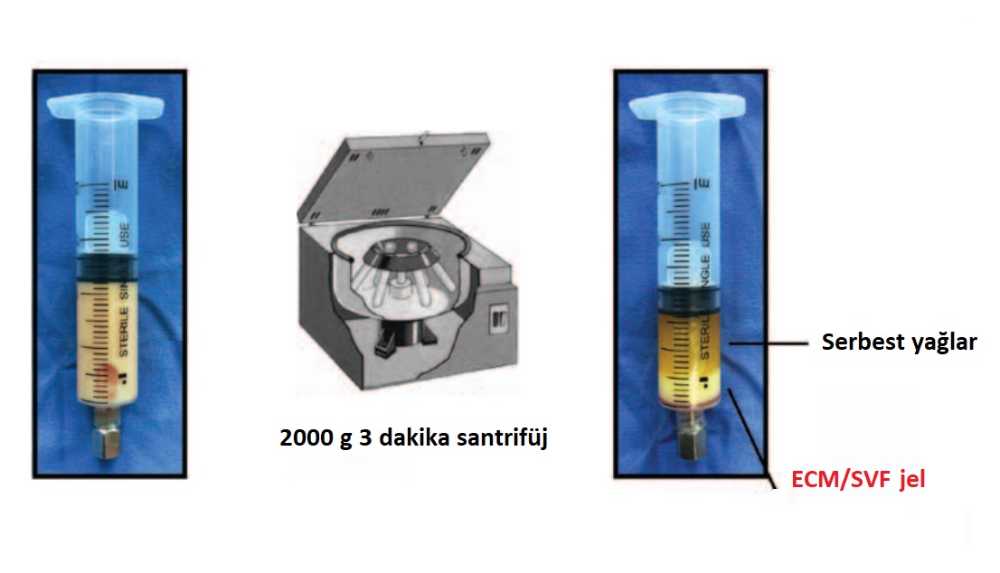 hucresel_tedavisvfadsc_jel_stromal_vaskuler_fraksiyon_yag_doku_kaynakli_kok_hucre_ciltyuz_genclestirme5.jpg