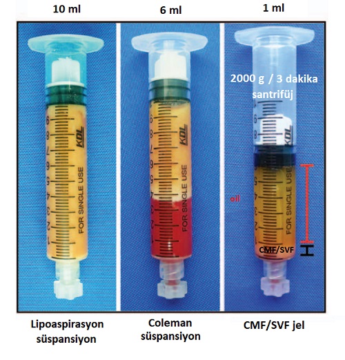 hucresel_tedavisvfadsc_jel_stromal_vaskuler_fraksiyon_yag_doku_kaynakli_kok_hucre_ciltyuz_genclestirme_7.jpg