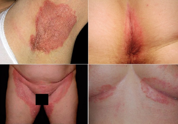inverse_psoriasis_flexural_psoriasis_ters_sedef_hastal_tutulum_alanlari.jpg