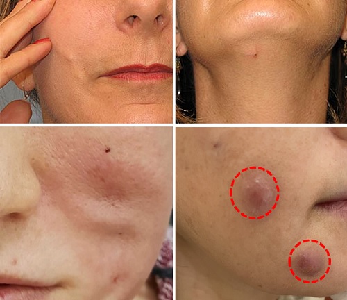 İplerle Yüz Askılama, Germe, Gençleştirme Uygulamaları Sonrası İstenmeyen Yan Etkiler