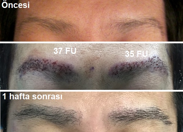 kas_ekimi_kas_ekimi_FUE_teknigi_2.jpg