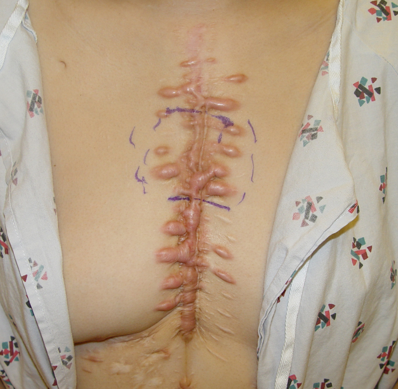 keloid.jpg