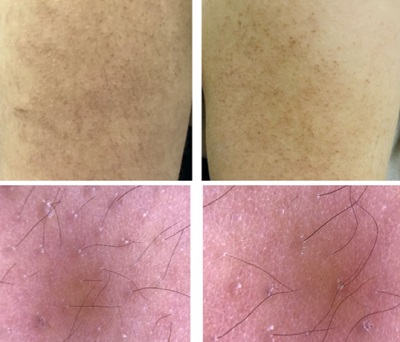 Keratosis Pilaris, Tavuk Derisi, Karbondioksit Lazer Tedavisi