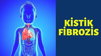 Kistik Fibrozis