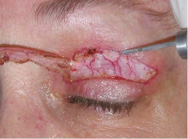 Lazer Blefaroplasti, Lazer Göz Kapağı Estetiği