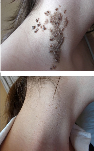 Epidermal Nevüs CO2 Lazer Tedavisi 