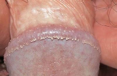 Pearly Penile Papules, Pearl penil papulosis, PPP, Tedavi, RF, Lazer Uygulaması