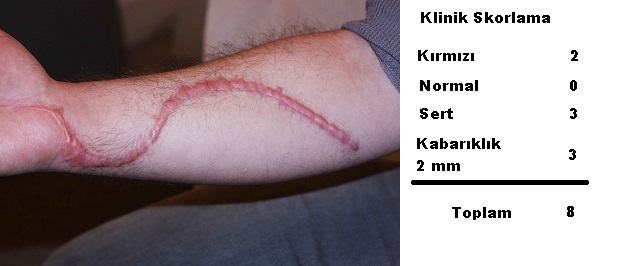 Hipertrofik Skar, Keloid Klinik Değerlendirme