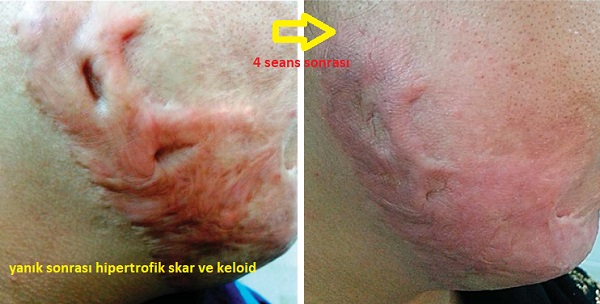 Hipertrofik Skar ve Keloidlerde Fraksiyonel Co2 lazer,  Verapamil, 5FU kullanımı