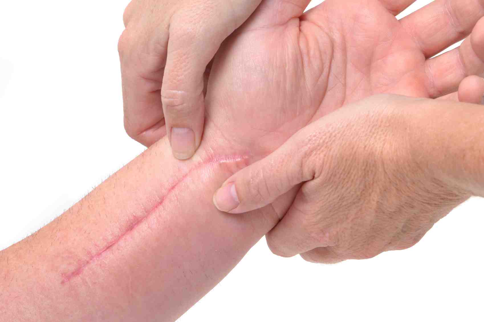Hipertrofik Skar ve Keloid