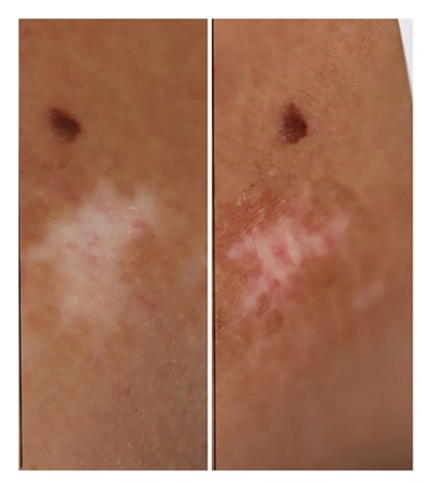 Vitiligo Tedavisi; Fraksiyonel Karbondioksit Lazer, 308 nm Excilite, Topikal Tacrolimus, D3 vitamini ve Kortizon Kombinasyonu