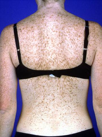 lentigo-simplex.jpg