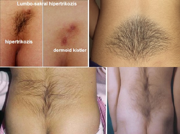 Aşırı Kıllanma, Hipetrikozis Nedenleri, Tedaviler