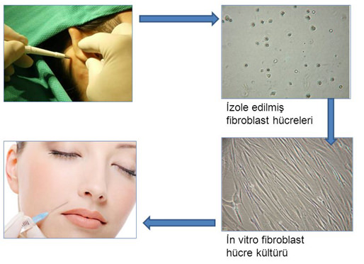 Otolog Fibroblast Hücre Tedavisi (Fibrocell)