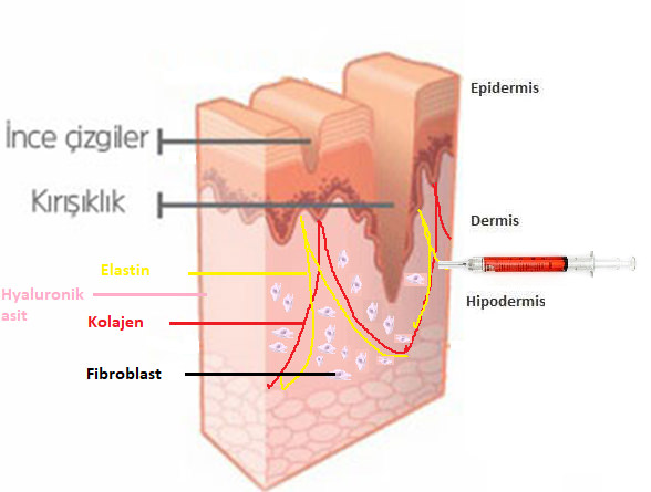 Otolog Fibroblast Hücre Tedavisi (Fibrocell)