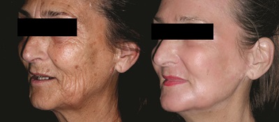 Cilt Lekelerinde, Lentigoda, Güneş Lekelerinde ve Melazmada Kimyasal Peeling