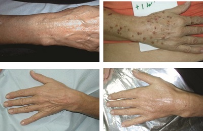 Ellerde Kimyasal Peeling