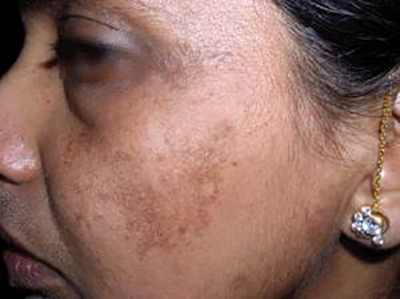 melasma.jpg