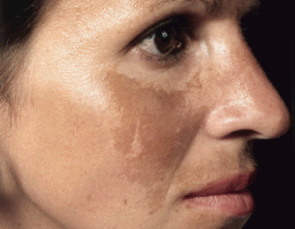 melasma_1.png