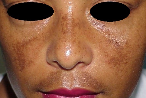 melasma_2.jpg