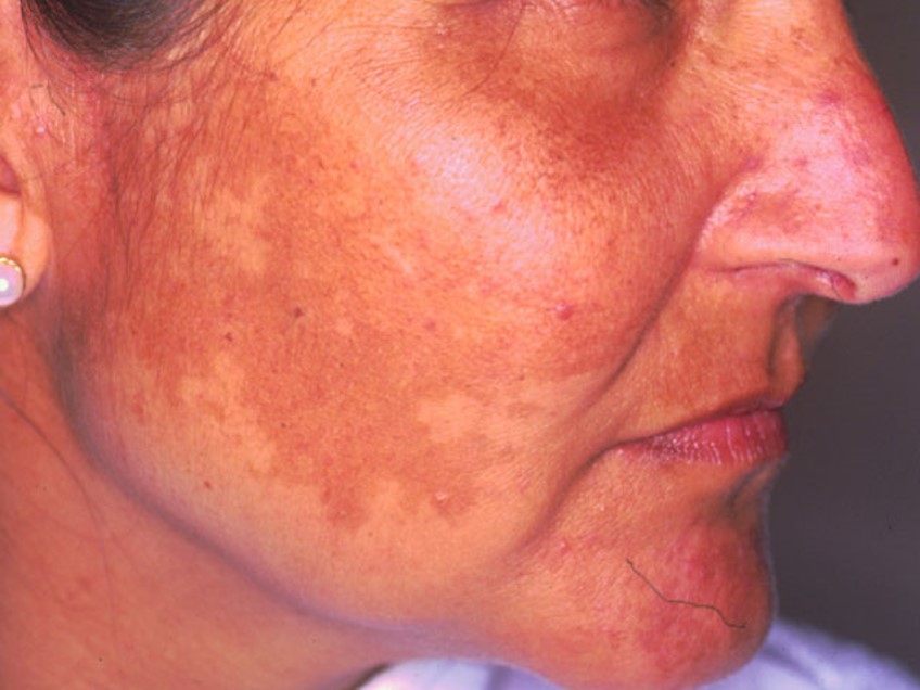 melasma_3.jpg