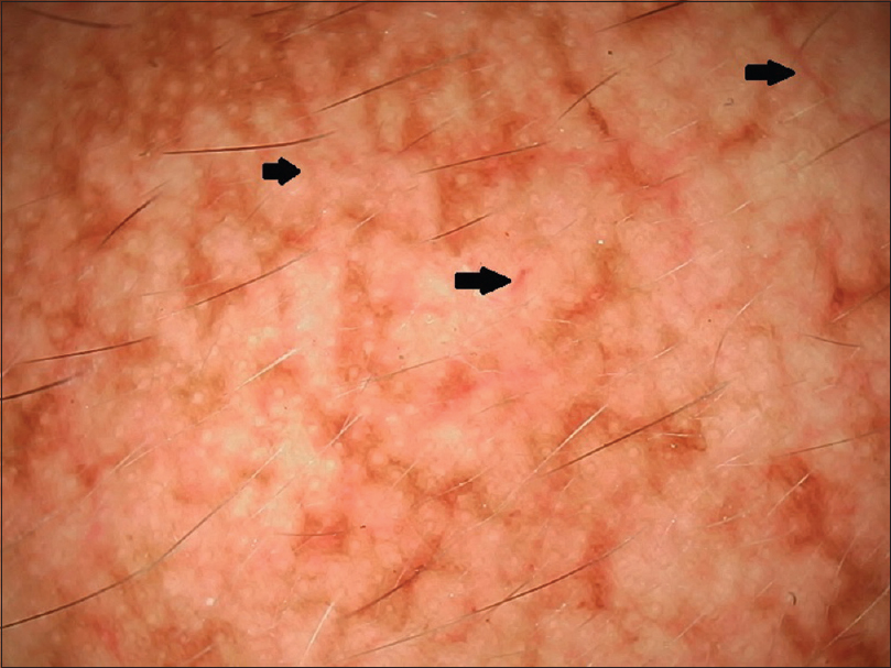 melasma_4.jpg
