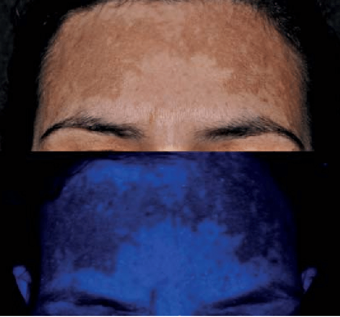 melasma_ve_wood_ışığı.png