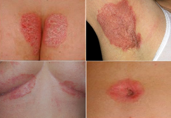 Inverse Psoriasis, İntertriginöz Sedef, Ters Sedef Hastalığı, Genital Sedef