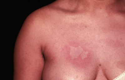 nevus_anemikus.jpg