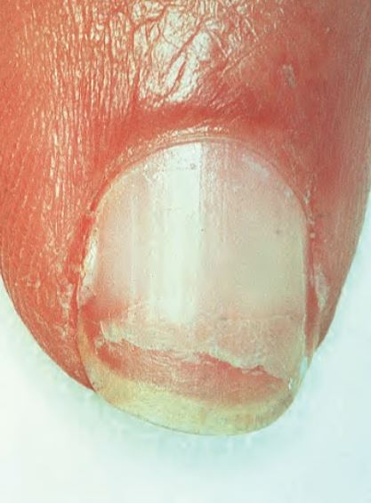 onikosizi-Onychoschizia.jpg