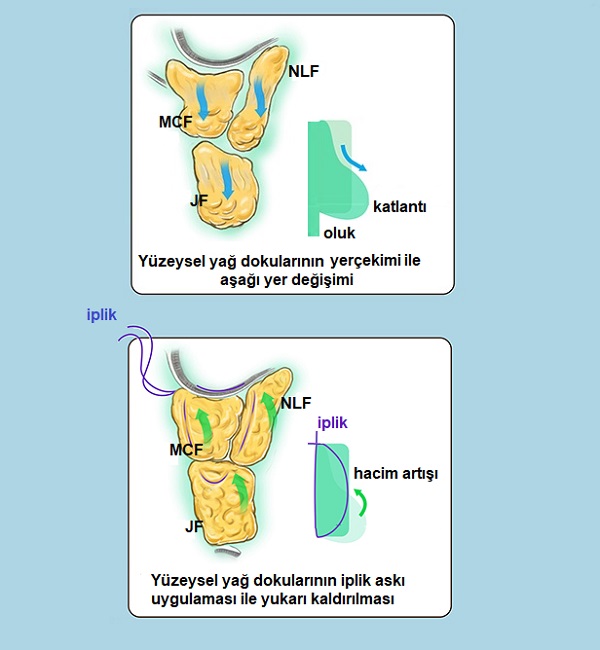 Orta Yüz  İplik Askı Uygulaması