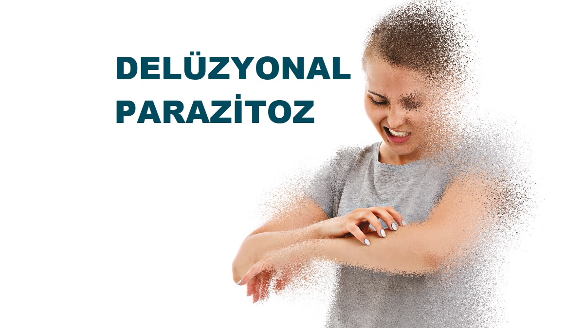 Sanrısal Delüzyonel Psikojenik Parazitoz