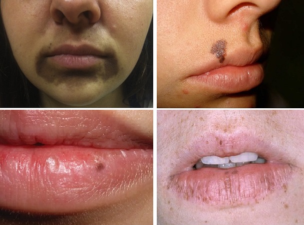 Ağız Çevresi Renklenme Perioral Pigmentasyon 