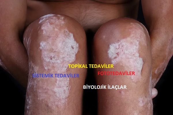 Plak Psoriazis Sedef Hastalığı Tedavisinde Güncel Prensipler