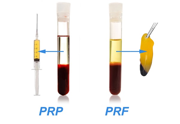 Plateletden Zengin Fibrin, PRF, 2. Jenerasyon PRP