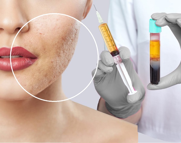 Akne İzlerinde PRG Fibrin Jel Dolgu Uygulamaları