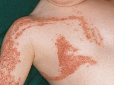 psoriazis_sedef_sedef_hastalg_ilven_hastalg_izgisel_sedef_hastalg.jpg