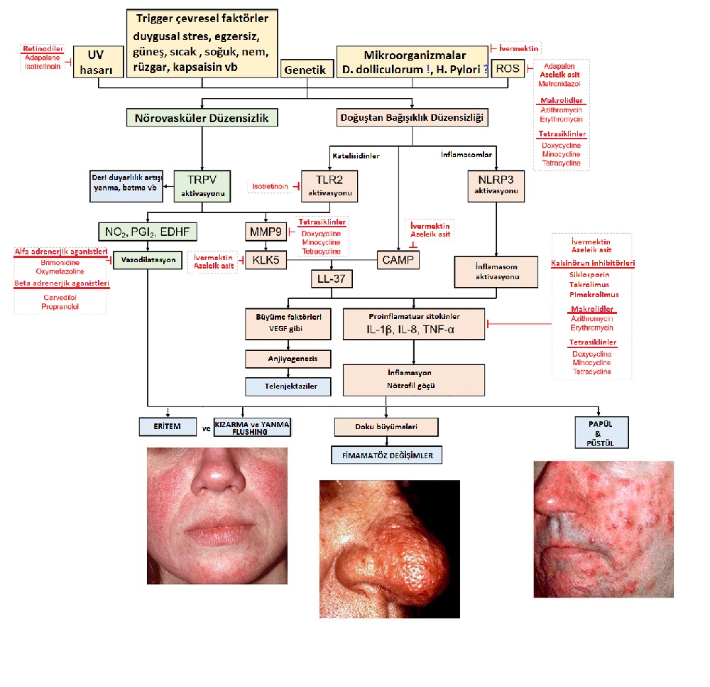 Rosacea, Roza Hastalığı, Nedenleri, Spesifik Tedaviler 