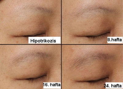 Kaş ve Kirpik Dökülmesi, Seyrekleşme, Hipotrikozis, Madaroz, Milfozis